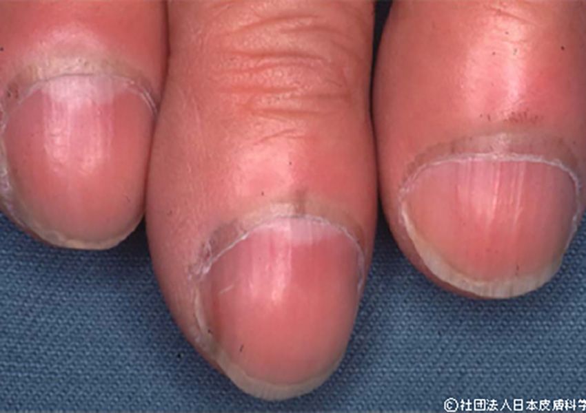 「爪が割れやすい」「巻き爪になりやすい」は糖尿病の疑いアリ。爪が発する病気のSOSとは - 4枚目の画像